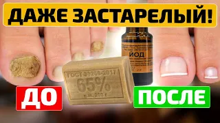 ТОЛЬКО ТАК ВЫЖЖЕТ грибок до корней! Народная медицина для лечения грибка ногтей