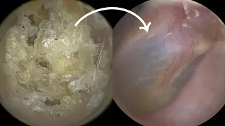 127 - Deeply Impacted Dead Skin Plug Removal & Peel using WAXscope®️ & new ZOOM feature