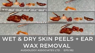 WET & DRY SKIN PEELS + EAR WAX REMOVAL - EP 182