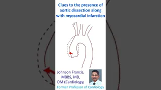 Clues to the presence of aortic dissection along with myocardial infarction