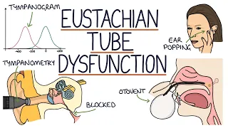 Understanding Eustachian Tube Dysfunction