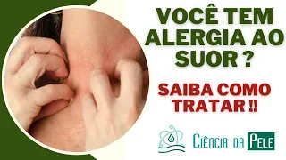 Você Tem Alergia Ao Suor? [SAIBA COMO TRATAR !!!]