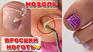 ВРОСШИЙ НОГОТЬ😢 Огромная подногтевая мозоль / Педикюр на себе / как удалить подногтевую мозоль