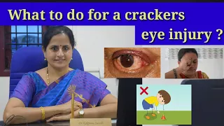 What to do if cracker💥 hits your Eye👁️?