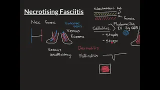 Necrotising Fasciitis