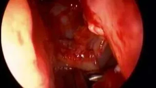 Endoscopic Sinus Surgery Basics