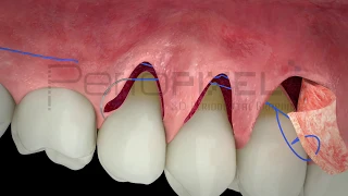 Tratamiento de múltiples recesiones gingivales adyacentes mediante ITC en túnel