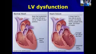 Ventricular Arrhythmias