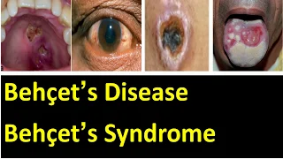 Behçet’s disease / behçet’s syndrome cause, symptoms, pathology, diagnosis and treatment