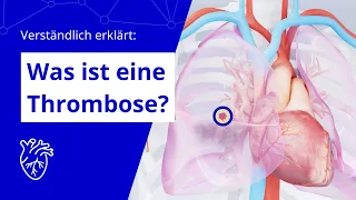 Verständlich erklärt: Was ist eine Thrombose?