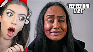 Mean Kids SHAME Girl With Acne.. What's Next Is Shocking