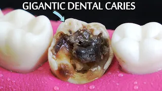INCREDIBLY SATISFYING Restoration Of Massive Tooth Decay | Root Canal And Crown Process.