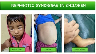 Nephrotic Syndrome - Causes | Clinical features | Pathophysiology | Investigations | Treatment
