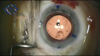 RayOne Toric (2022) implantation by Mr Allon Barsam, OCL Vision