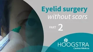 Eyelid surgery without scars - Part 2
