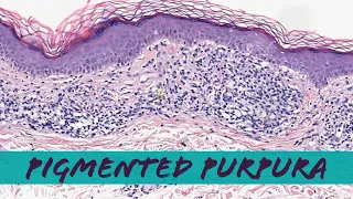 Pigmented Purpuric Dermatosis (Schamberg disease, lichen aureus, etc) pathology dermatology