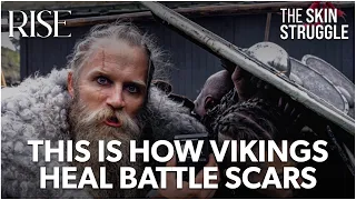 VIKINGS LIKE THOR USE RISE FOR THEIR BATTLE SCARS FROM THE SKIN STRUGGLE