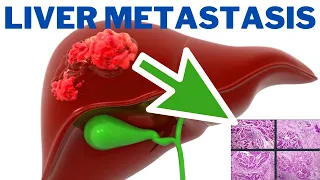 Liver Metastasis - What does liver metastases feel like? | 247nht