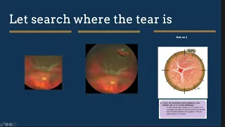 Lecture Vitrectomy vs buckle: indication for surgery in retinal detachment