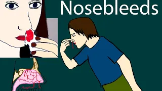 Nosebleeds (Epistaxis): Types, Causes, Treatment & Prevention