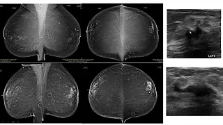 Breast Pathology - Infiltrating Lobular Carcinoma (ILC)