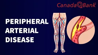 Peripheral Arterial Disease