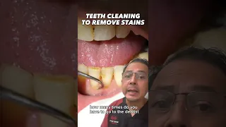 Removing Stains and Calculus from a Smoker’s Teeth | In Office to Hands On Dental Training #shorts