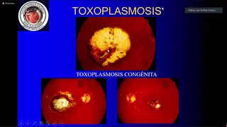 Uveitis Posterior parte 1