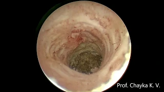 Treatment of isthmocele/Лечение истмоцеле