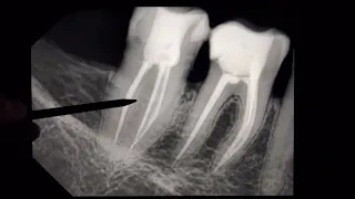 Диагностика периодонтита. Киста зуба на томографии. Одонтогенный гайморит. Гранулёма зуба. Антанян