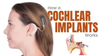 Cochlear Implants: What are they and How do they work? - 3D Guide