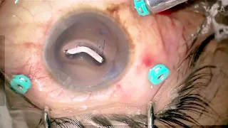 IOFB Removal