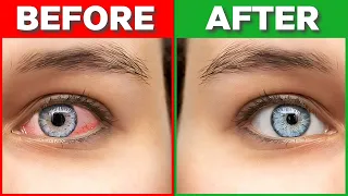 How To Get Rid of Pink Eye in 2024