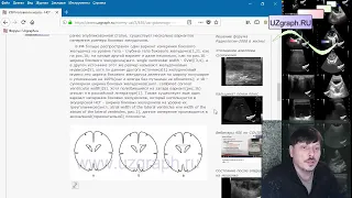 Аудио-статья: Нормы УЗИ - УЗИ головного мозга - Нейросонография - НСГ - у детей норма