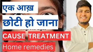 एक आख़ छोटी हो जाना | If one of your eye is smaller Causes ,Treatment and home remedies.