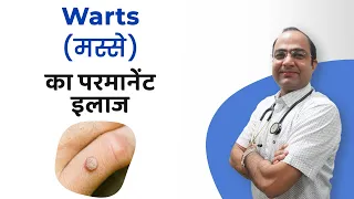 मस्सो का परमानेंट इलाज | Warts Treatment Success | Best Treatment of Warts | Best Homeopathic Doctor