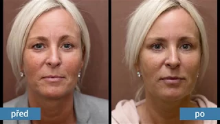 Anti-aging techniky místo plastické operace víček