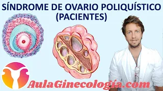 SÍNDROME DE OVARIO POLIQUÍSTICO (PACIENTES), SOP: síntomas y diagnóstico - Ginecología y Obstetricia
