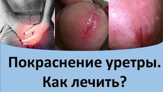 Покраснение уретры  Как лечить?