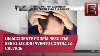 Descubren por accidente cura para la calvicie