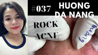 #037 | Get ROCK ACNE for lady | Lấy mụn đá | Acne treatment Hương Đà Nẵng Official