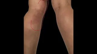 POCUS - Soft Tissue Ultrasound - Superficial Thrombophlebitis