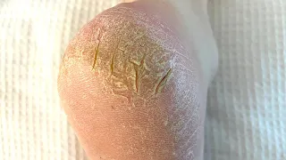 Severely Cracked Callused And Painful Heel Is Treated | Satisfying Skin Removal