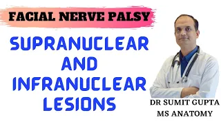 FACIAL NERVE PALSY