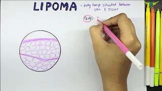 Lipoma Histopathology | Benign Mesenchymal tumor Histopathology | Gross | Microscopy