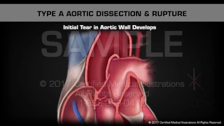 Type A Aortic Dissection & Rupture