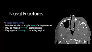 Imaging of Maxillo facial trauma   Dr Mamdouh Mahfouz