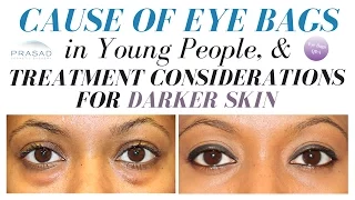 The Cause of Eye Bags in Young People, and Considerations for Dark Skin Lower Eyelid Surgery