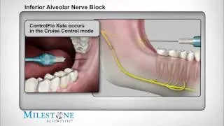 Inferior Alveolar Nerve Block