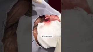 🌋 A Volcanic Removal From a Nose! #shorts #drpimplepopper #pimplepopping